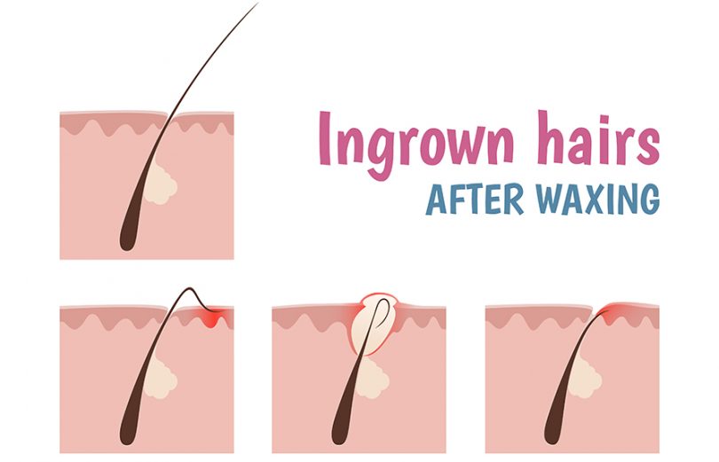 How To Get Rid Of Ingrown Hairs